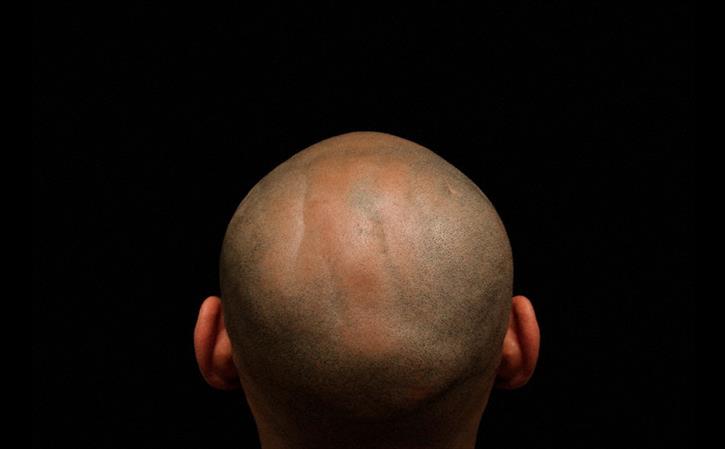 Treatment for Baldness in Homeopathy